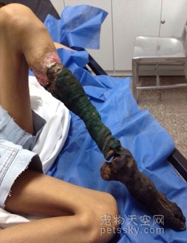13岁女孩被蛇咬后未及时处理 一条腿腐烂成骨架