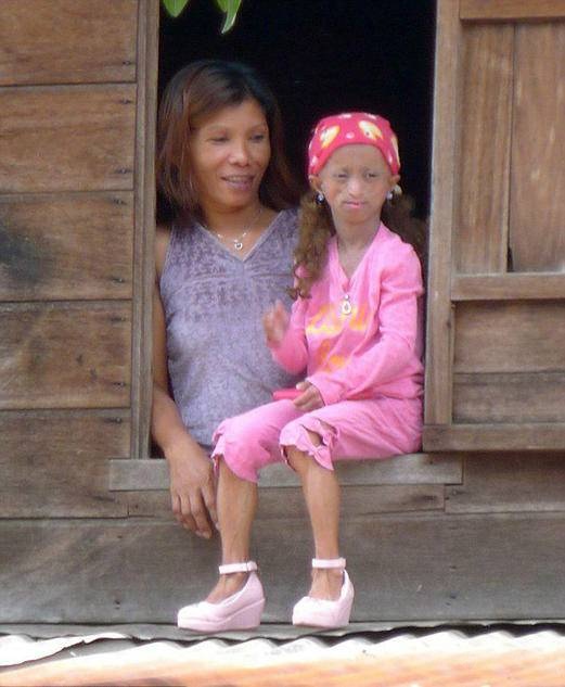 亚洲“最老女孩”去世 年仅19岁身体却已经150岁
