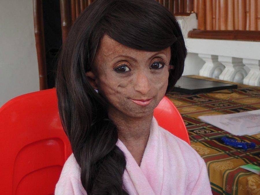 亚洲“最老女孩”去世 年仅19岁身体却已经150岁